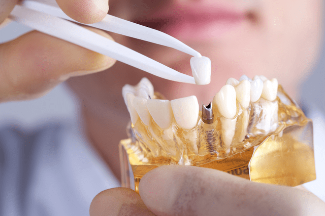 Dental Implants a Good Investment