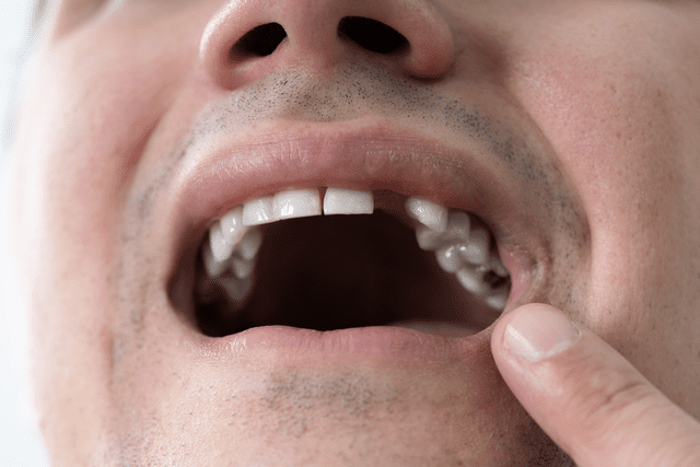 Maintaining Your Mouth Health After a Tooth Extraction