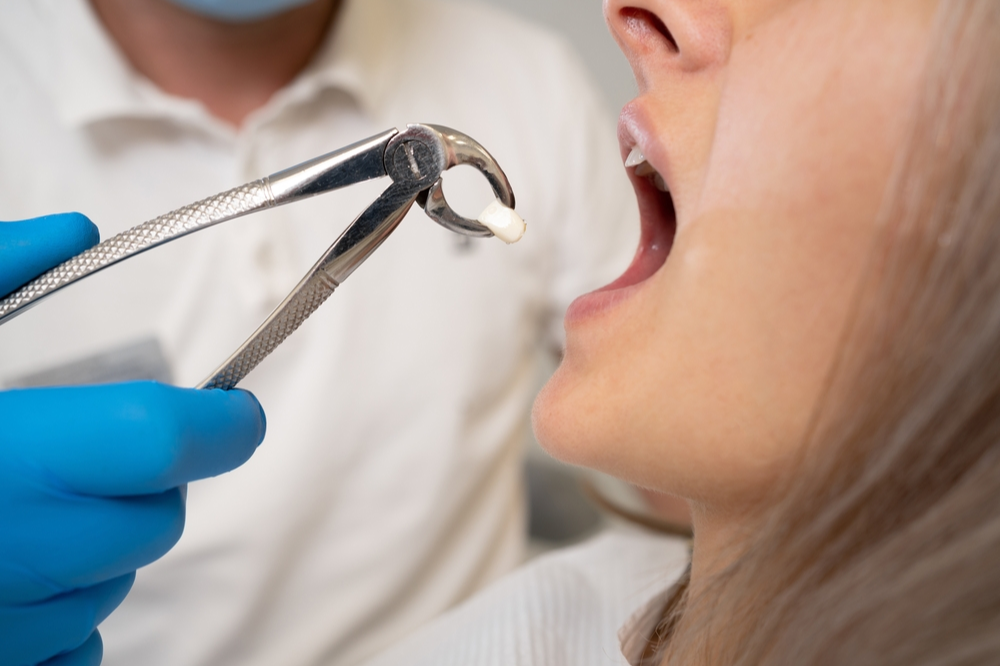 What Should a Tooth Extraction Look Like When Healing