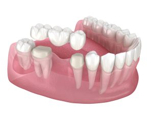 Can a Dental Bridge Replace Multiple Missing Teeth Effectively