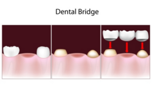 dental-bridges-for-restoring-oral-function