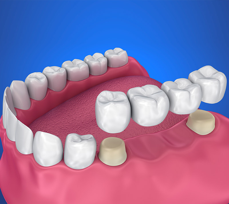 dental bridges near you