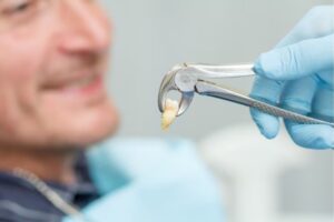 tooth extractions in Rocky Mountain House