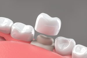 Porcelain vs. Zirconium vs. Gold Crowns: Which One Is Best for Your Tooth