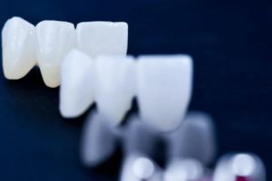 what types of dental bridges are available